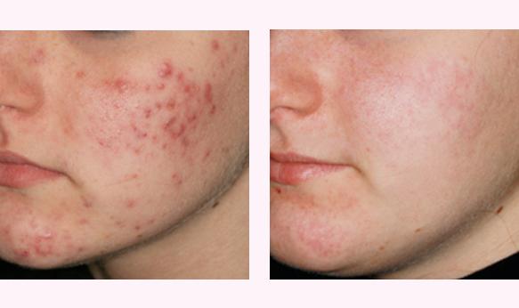 Trattamento acne My Beauty Studio Estetico di Enrica Frau - Senorbì (SU)